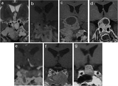 Clinical, Laboratory, and Treatment Profiles of Silent Corticotroph Adenomas That Have Transformed to the Functional Type: A Case Series With a Literature Review